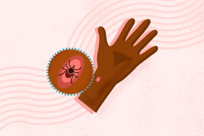 What Is Lyme Disease?
