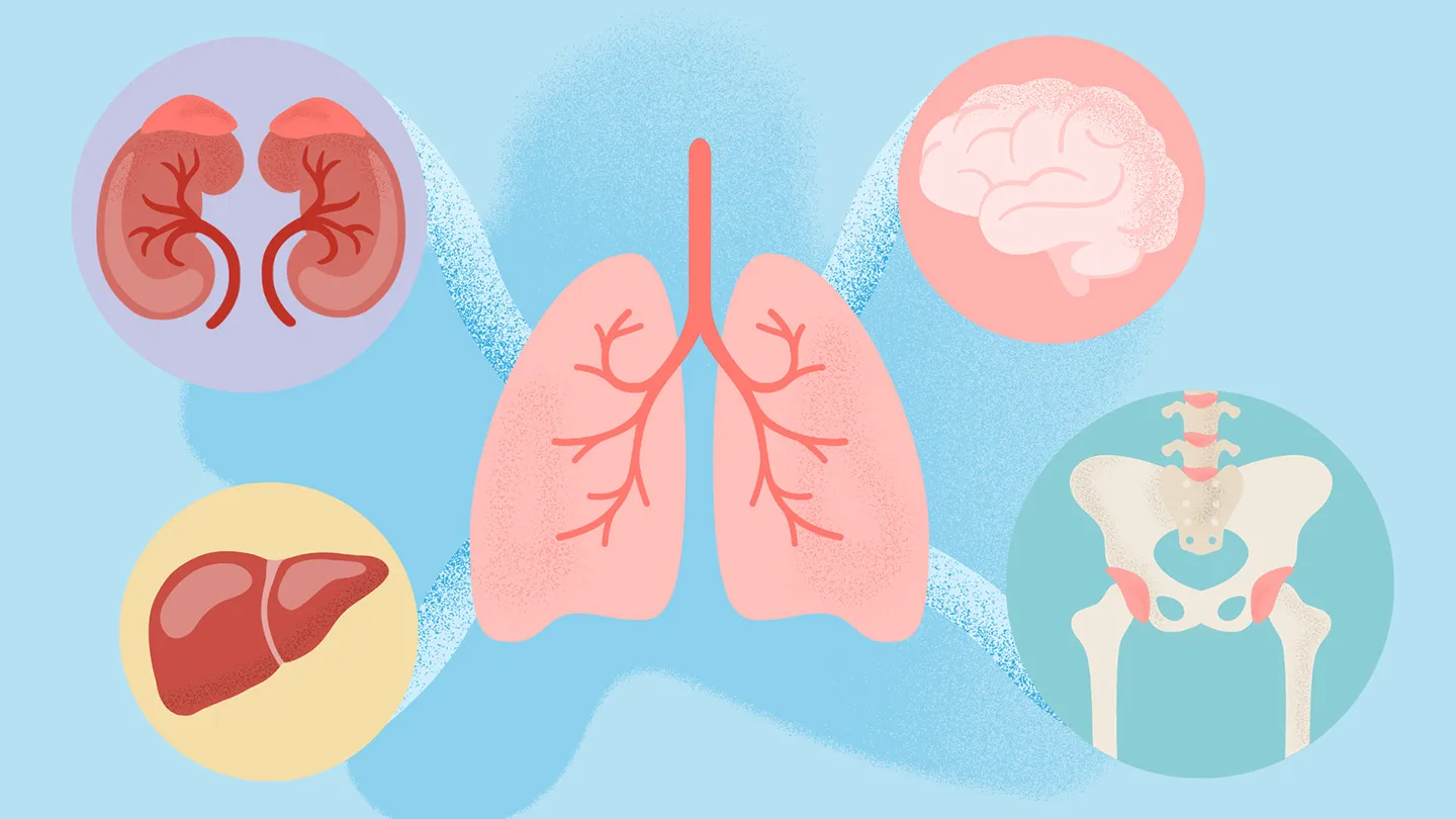 How Lung Cancer Spreads: Tracking Metastasis Paths