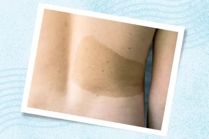 What Is Neurofibromatosis Type 1 (NF1)?