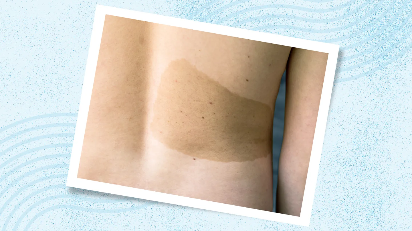 What Is Neurofibromatosis Type 1 (NF1)?